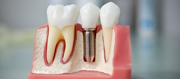 все этапы имплантации зубов